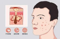 下巴长了痤疮怎么治疗护理