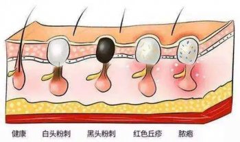 南京祛痘哪家好