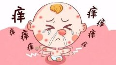 湿疹的治疗方法有哪些